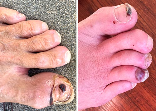 Deformed foot limits walking