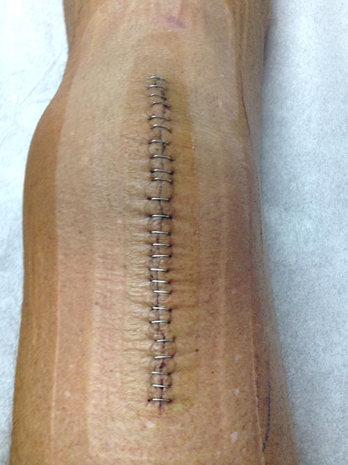 Knee staples