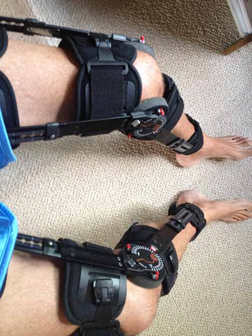 Bilateral knee surgeries